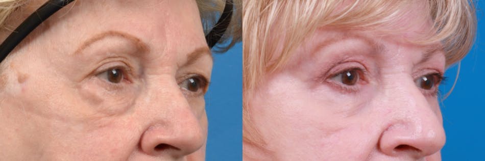 Skin Resurfacing Before & After Gallery - Patient 122406927 - Image 3