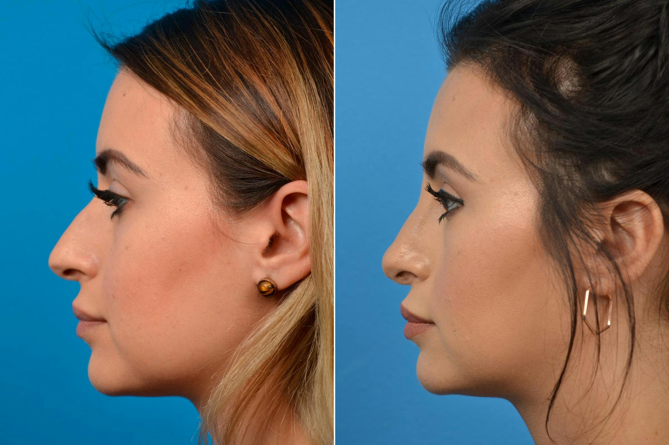 Rhinoplasty Before & After Gallery - Patient 122406929 - Image 3