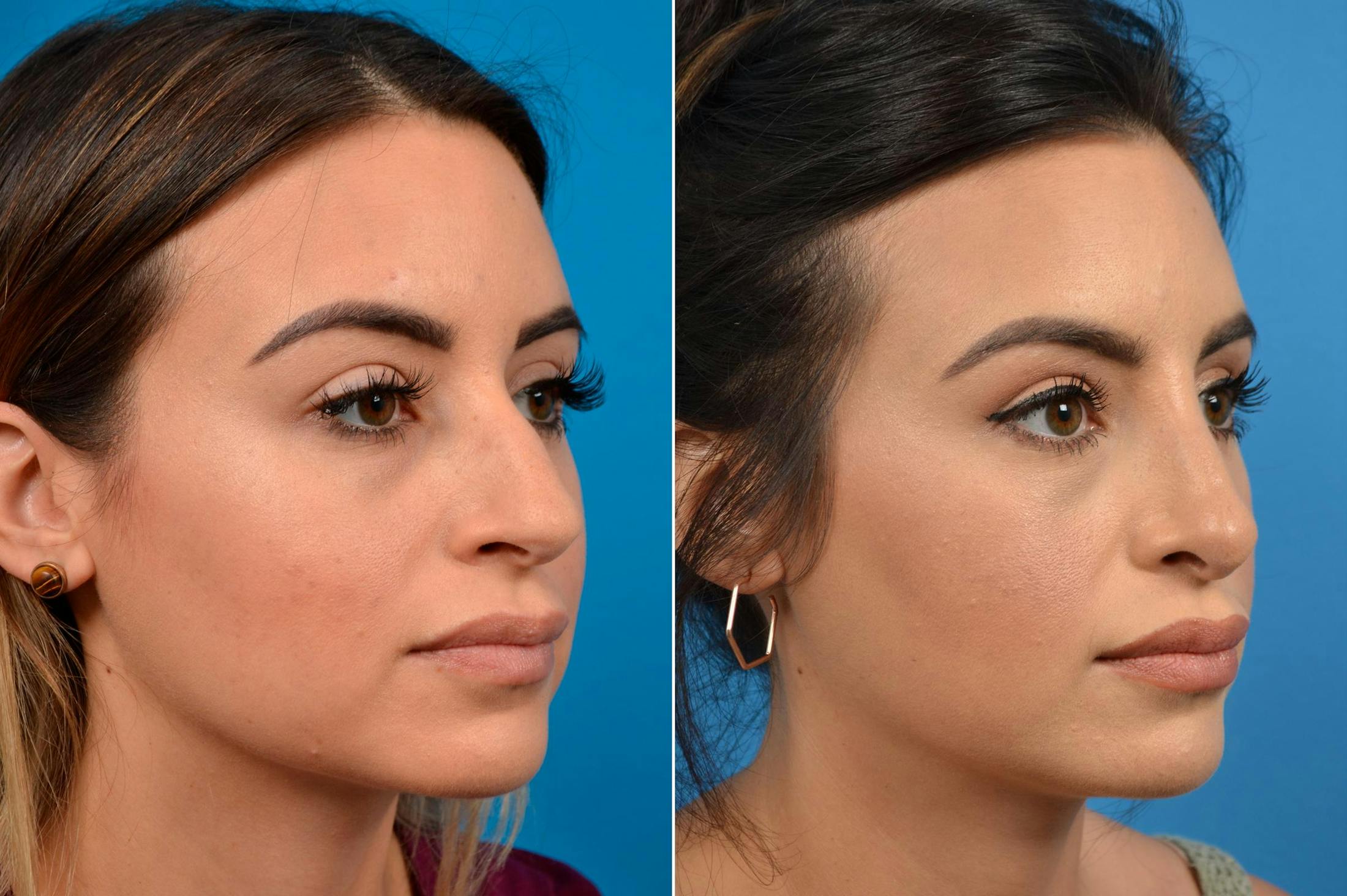 Rhinoplasty Before & After Gallery - Patient 122406929 - Image 4
