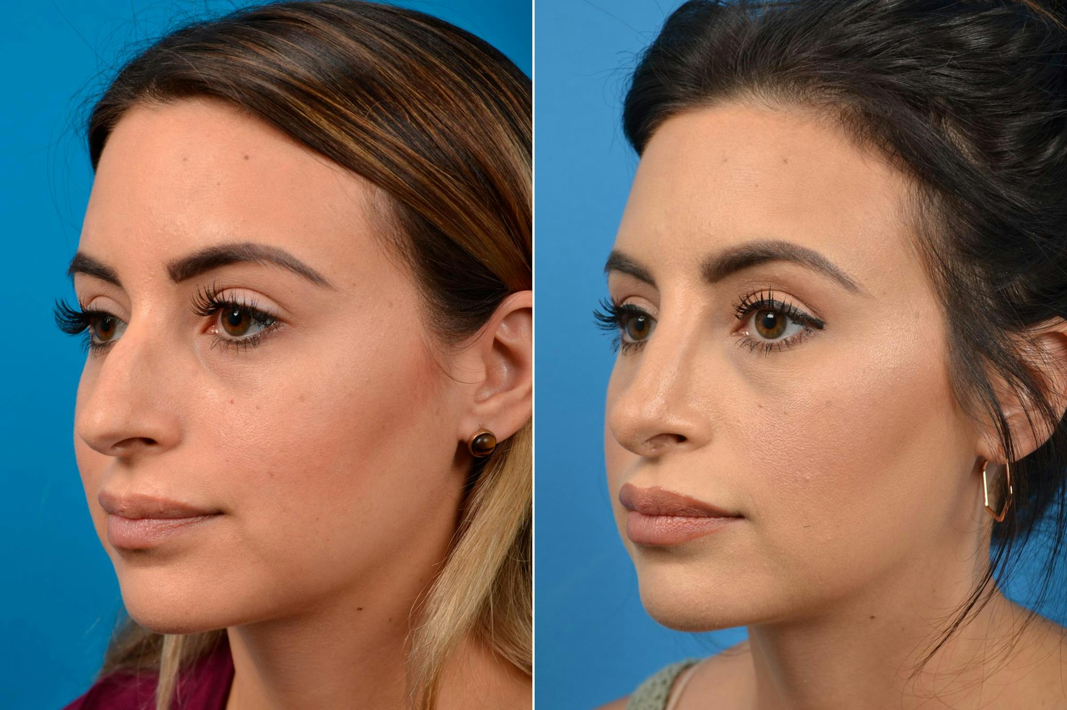 Rhinoplasty Before & After Gallery - Patient 122406929 - Image 5