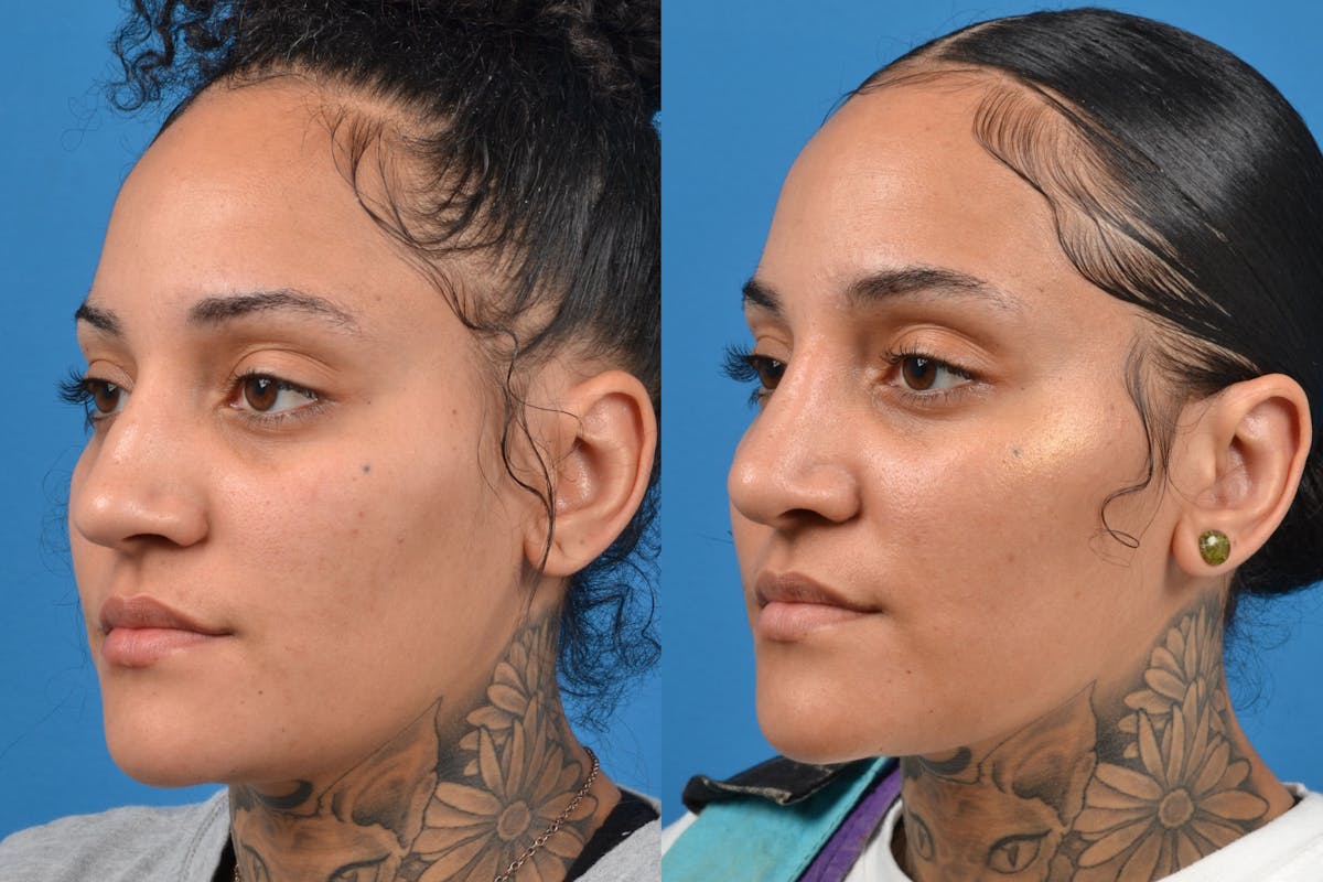 Rhinoplasty Before & After Gallery - Patient 122406931 - Image 2