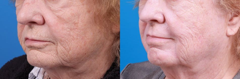 Skin Resurfacing Before & After Gallery - Patient 122406932 - Image 1