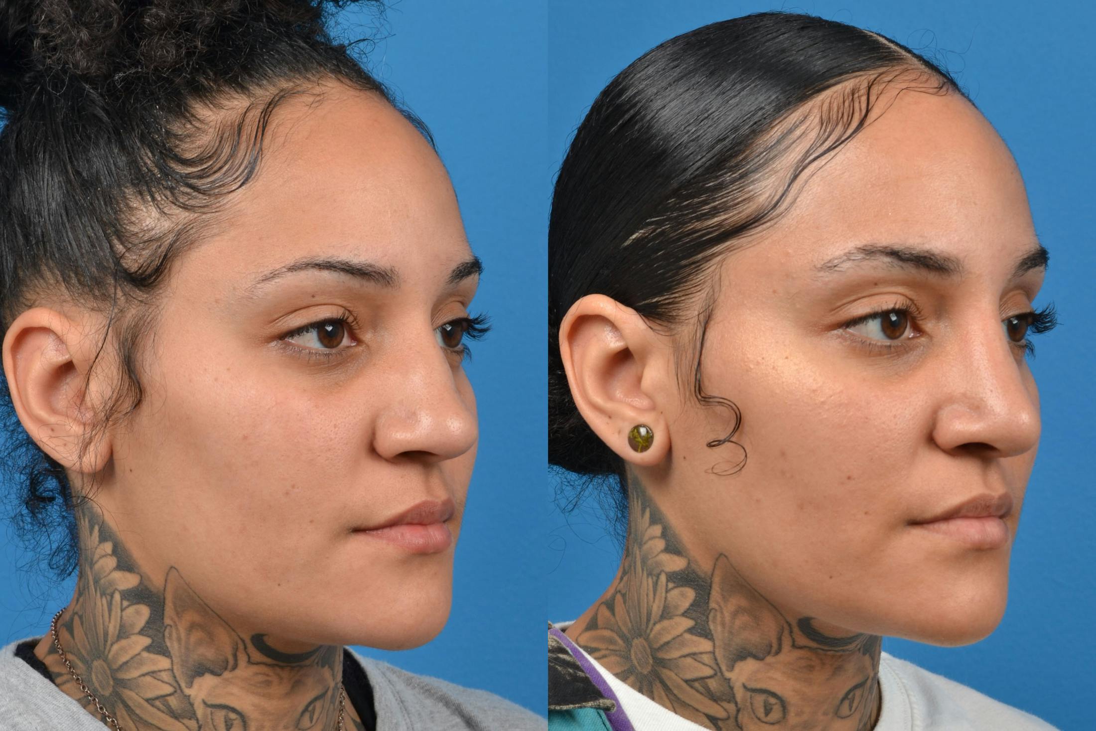 Rhinoplasty Before & After Gallery - Patient 122406931 - Image 3