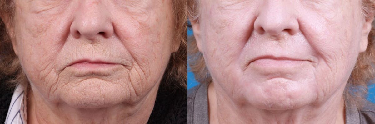 Skin Resurfacing Before & After Gallery - Patient 122406932 - Image 2