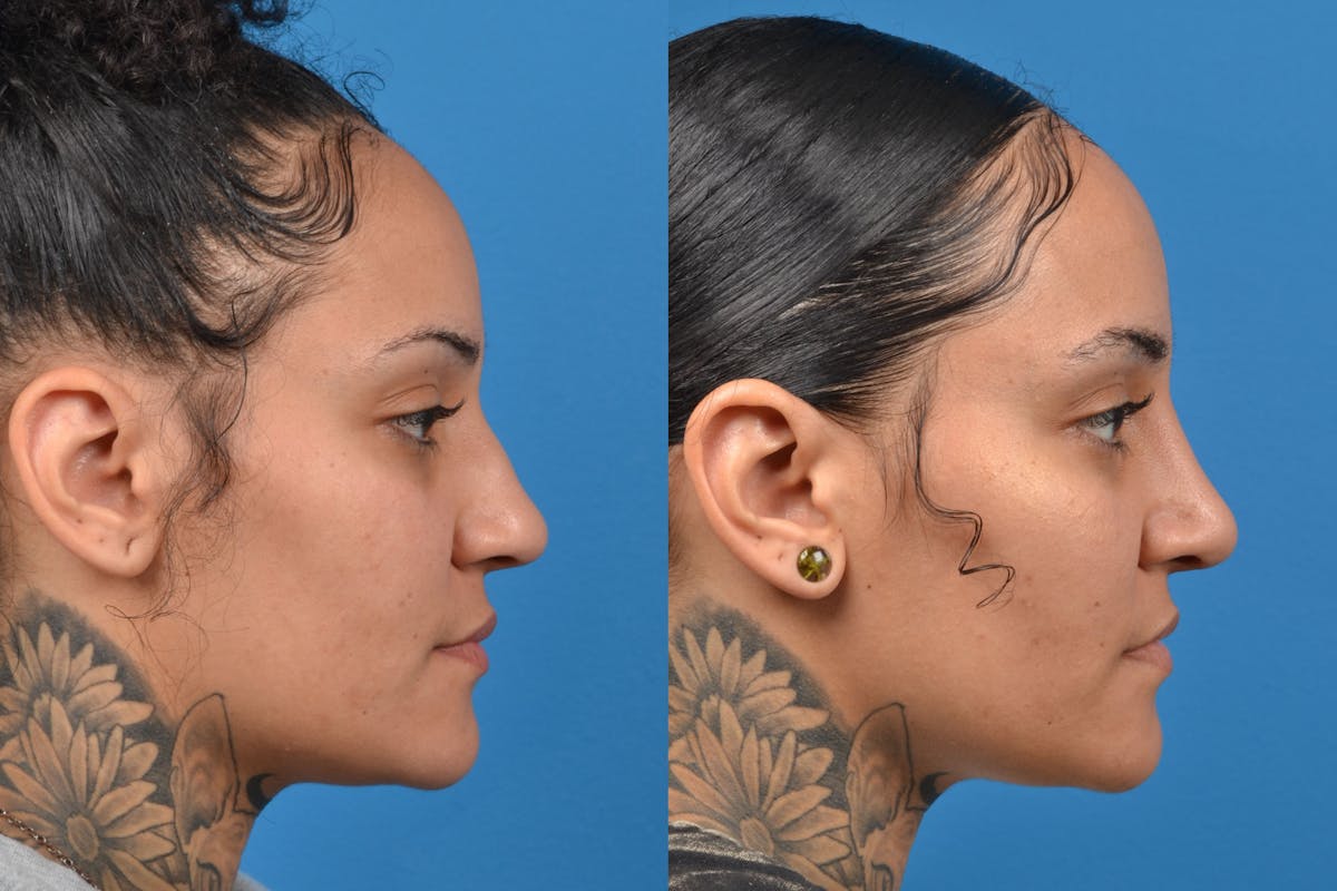 Rhinoplasty Before & After Gallery - Patient 122406931 - Image 4