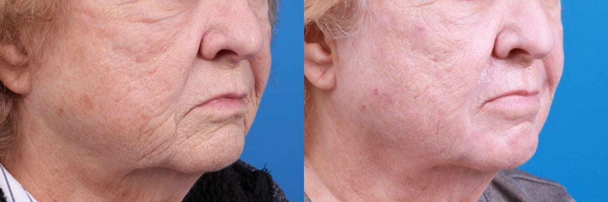 Skin Resurfacing Before & After Gallery - Patient 122406932 - Image 3