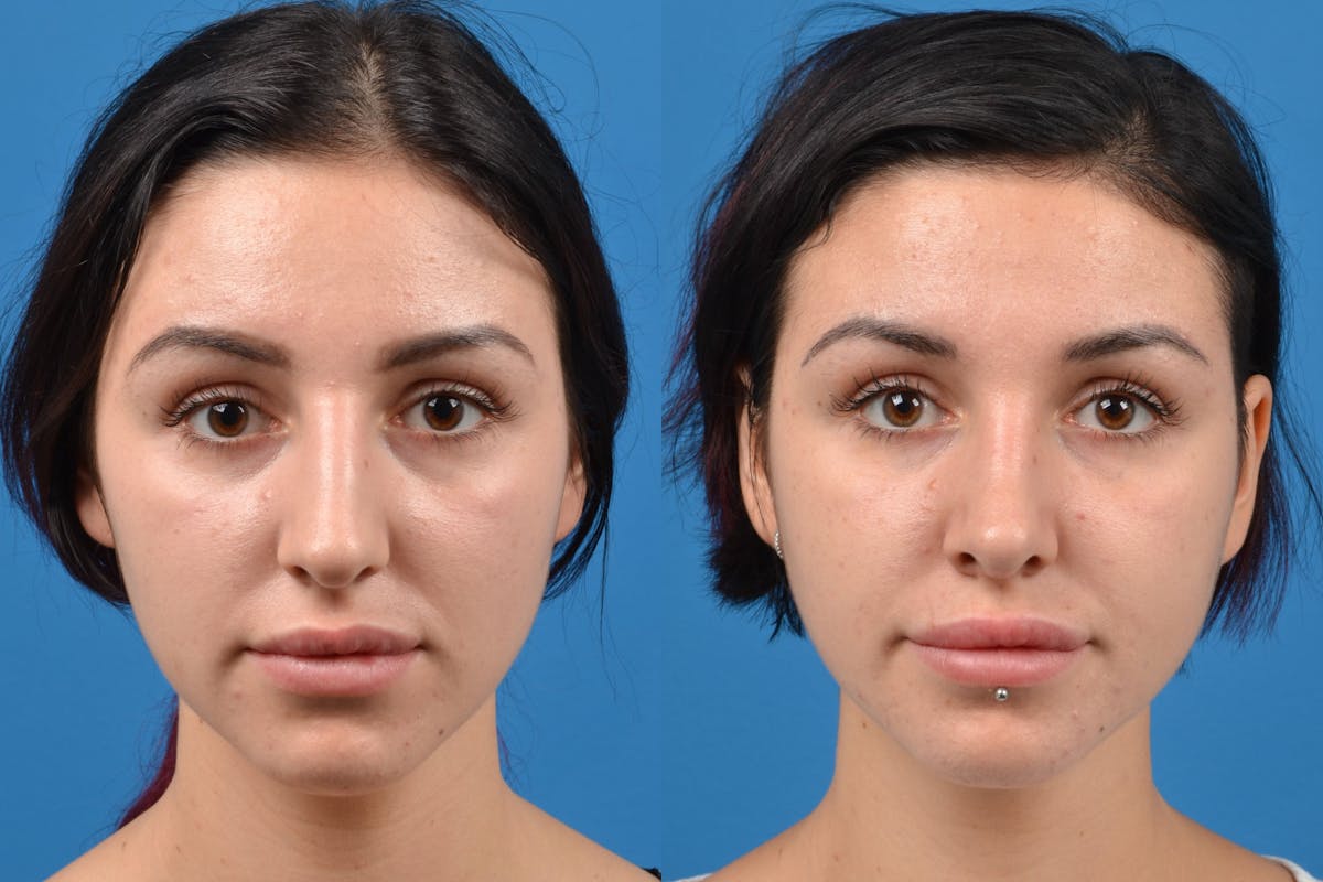 Rhinoplasty Before & After Gallery - Patient 122406935 - Image 1
