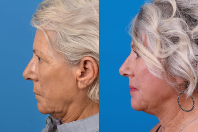 Skin Resurfacing Before & After Gallery - Patient 122406934 - Image 1