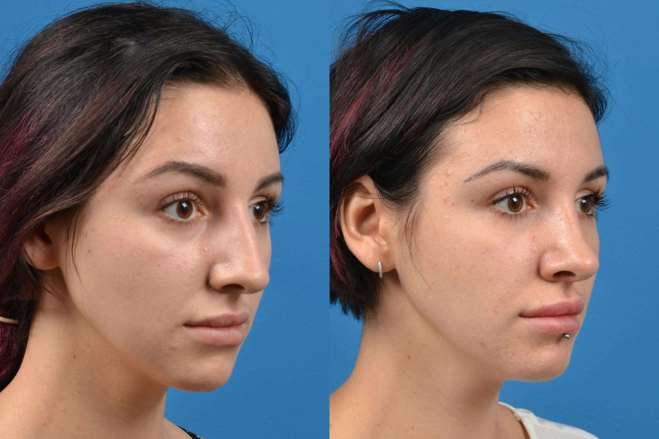 Rhinoplasty Before & After Gallery - Patient 122406935 - Image 2