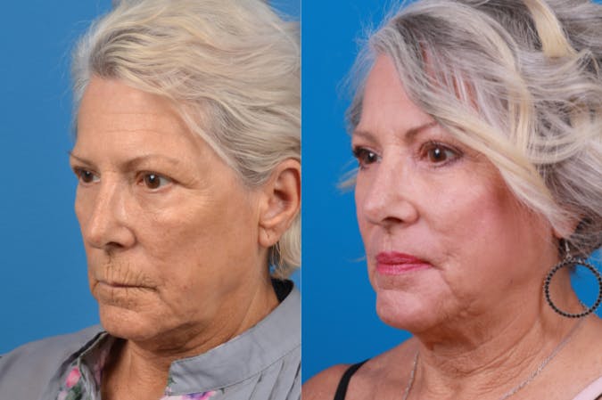 Skin Resurfacing Before & After Gallery - Patient 122406934 - Image 2