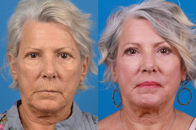 Skin Resurfacing Before & After Gallery - Patient 122406934 - Image 3