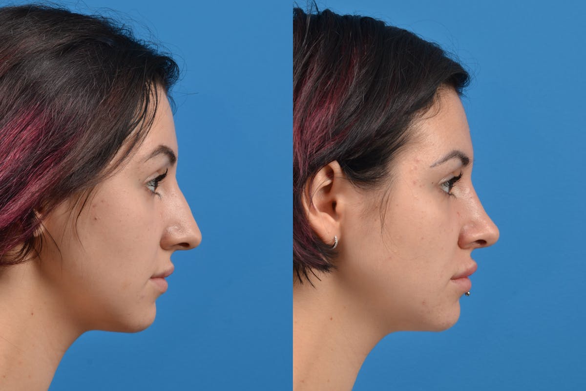 Rhinoplasty Before & After Gallery - Patient 122406935 - Image 3