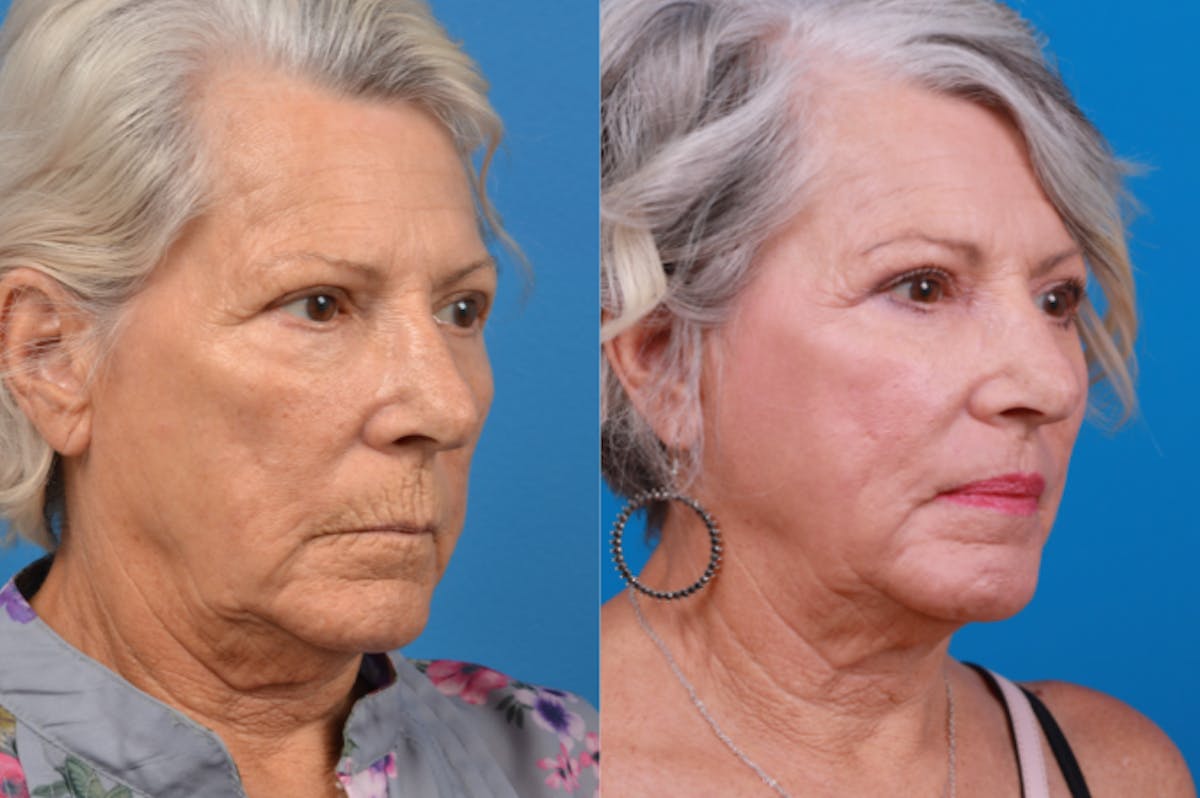 Skin Resurfacing Before & After Gallery - Patient 122406934 - Image 4