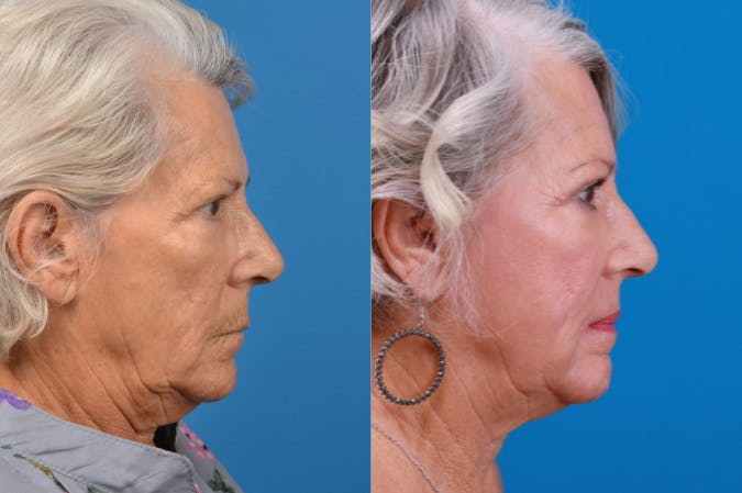 Skin Resurfacing Before & After Gallery - Patient 122406934 - Image 5