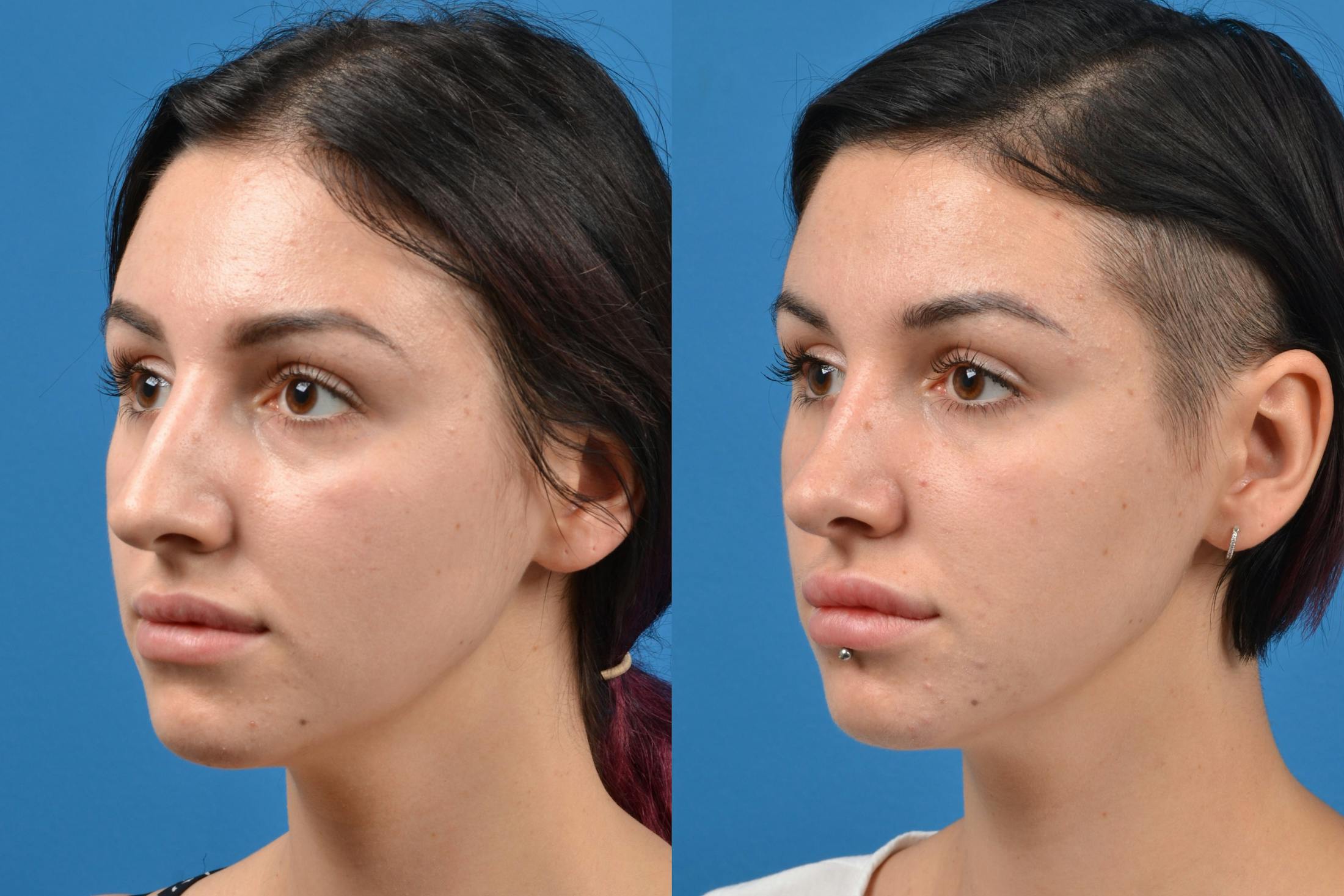 Rhinoplasty Before & After Gallery - Patient 122406935 - Image 4