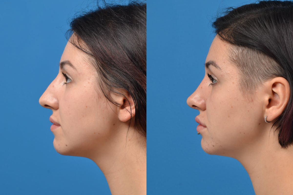 Rhinoplasty Before & After Gallery - Patient 122406935 - Image 5