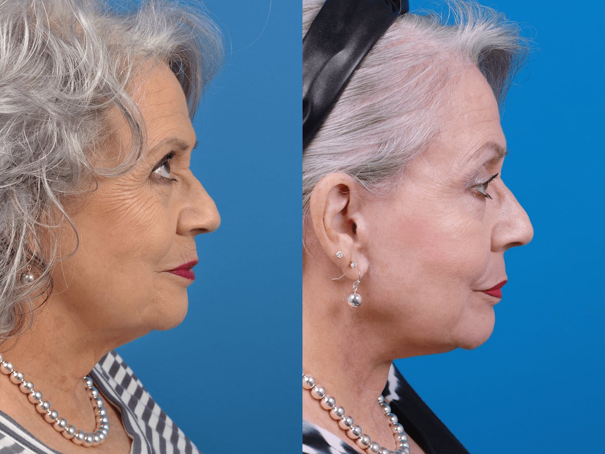 Skin Resurfacing Before & After Gallery - Patient 122406936 - Image 2