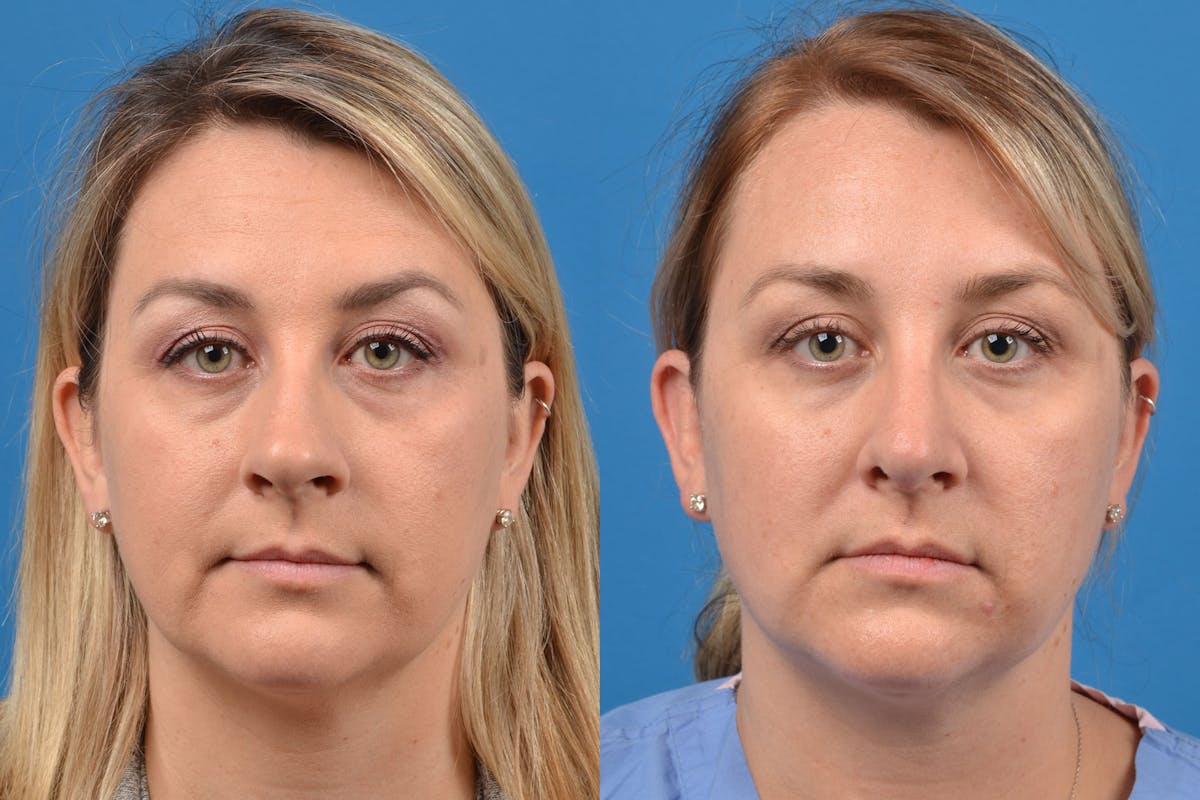 Rhinoplasty Before & After Gallery - Patient 122406937 - Image 1