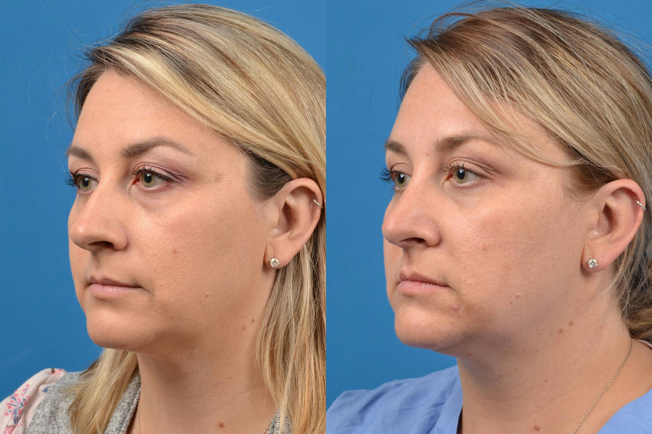 Rhinoplasty Before & After Gallery - Patient 122406937 - Image 2
