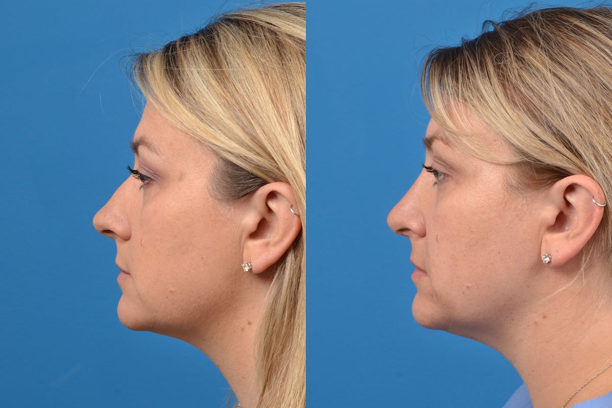 Rhinoplasty Before & After Gallery - Patient 122406937 - Image 3