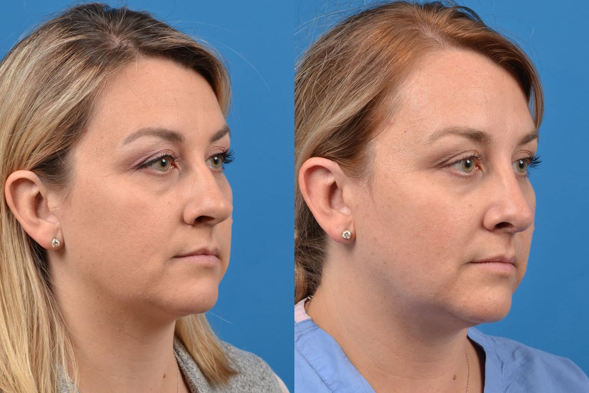 Rhinoplasty Before & After Gallery - Patient 122406937 - Image 4