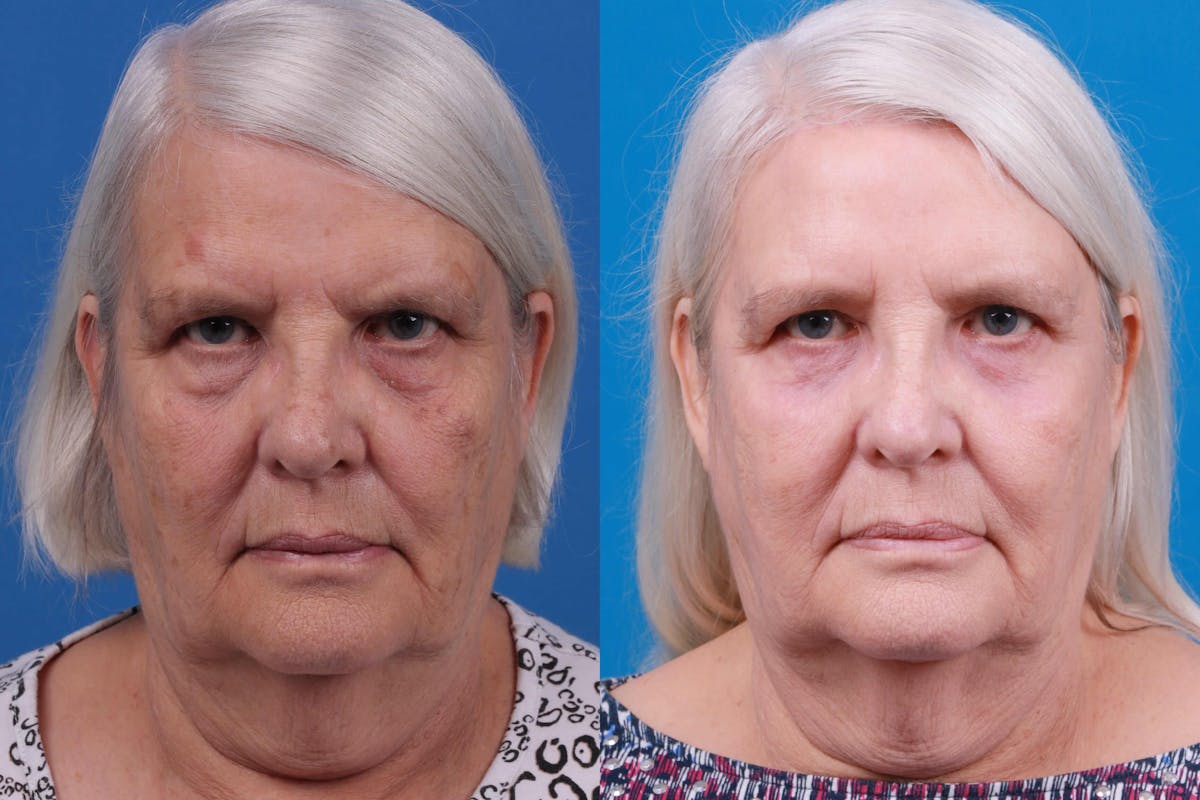 Skin Resurfacing Before & After Gallery - Patient 122406938 - Image 1