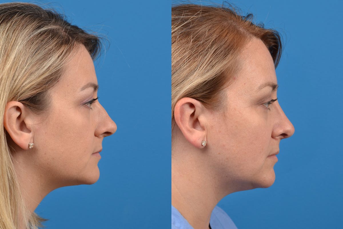 Rhinoplasty Before & After Gallery - Patient 122406937 - Image 5