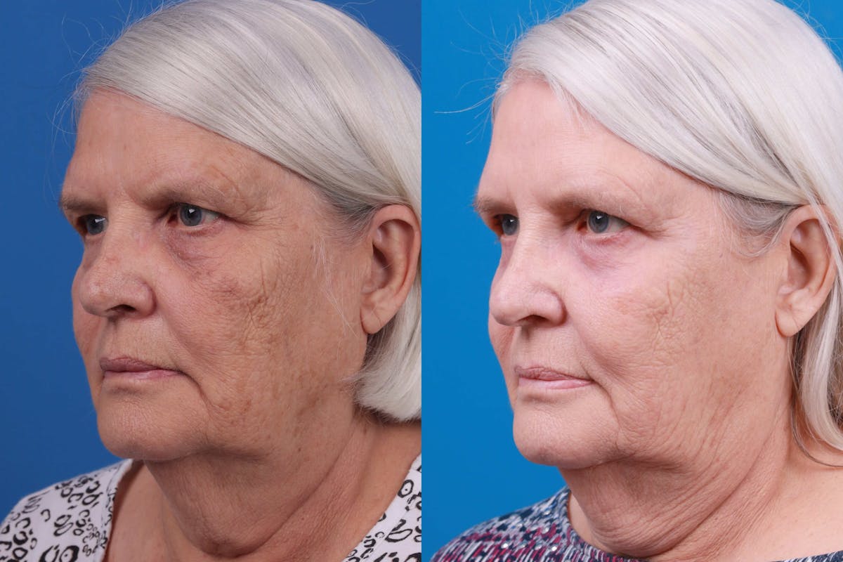 Skin Resurfacing Before & After Gallery - Patient 122406938 - Image 2