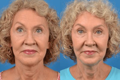 Rhinoplasty Before & After Gallery - Patient 122406939 - Image 1