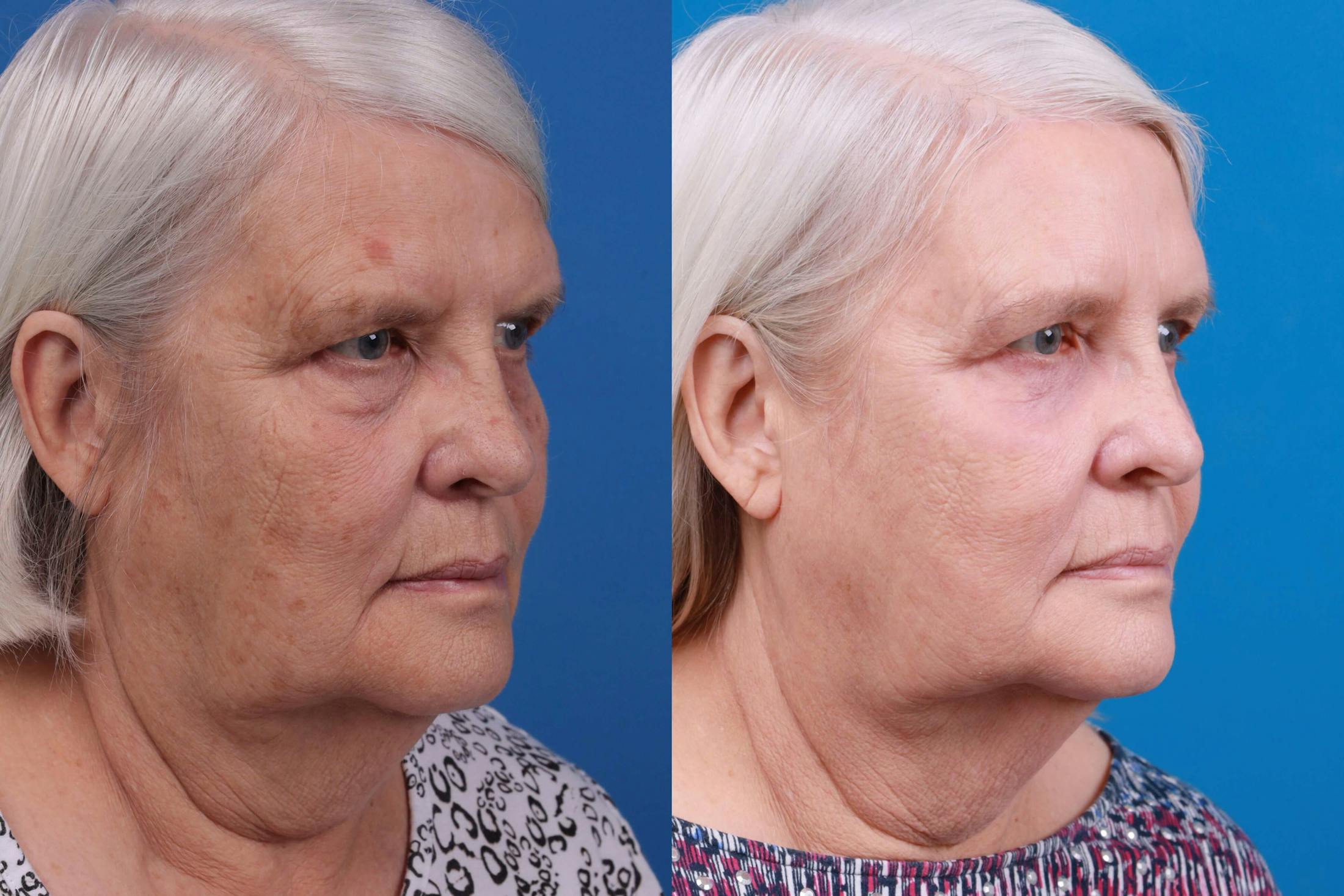 Skin Resurfacing Before & After Gallery - Patient 122406938 - Image 3