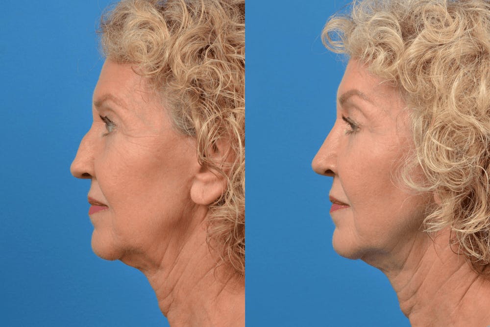 Rhinoplasty Before & After Gallery - Patient 122406939 - Image 2