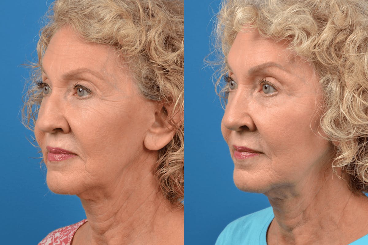 Rhinoplasty Before & After Gallery - Patient 122406939 - Image 3