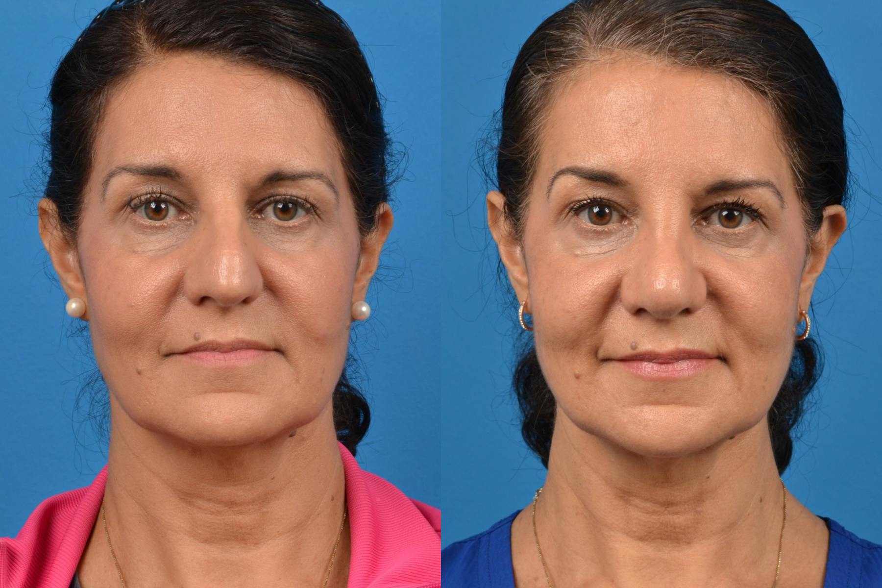 Rhinoplasty Before & After Gallery - Patient 122406940 - Image 1