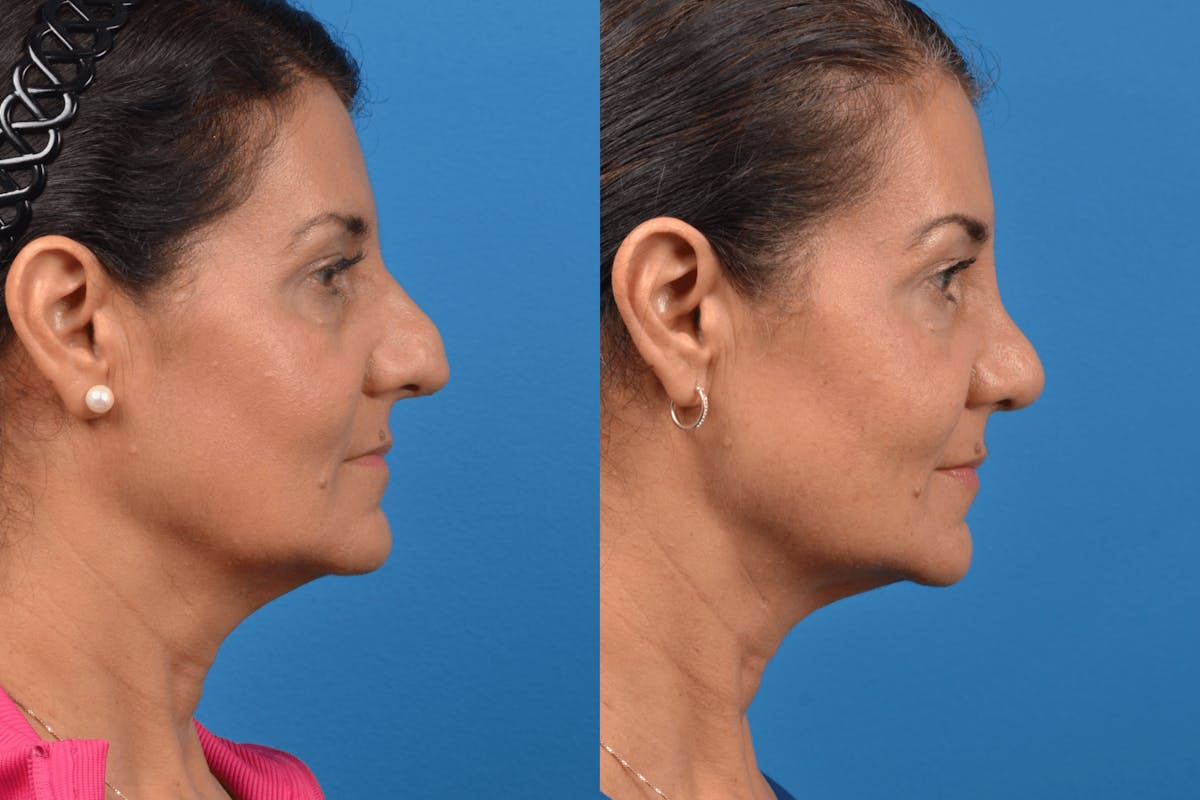 Rhinoplasty Before & After Gallery - Patient 122406940 - Image 2