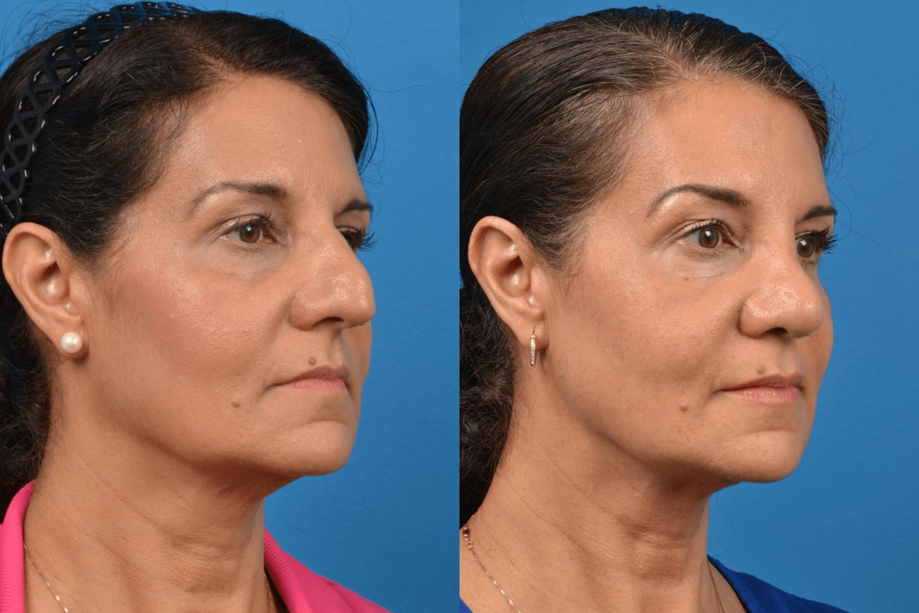 Rhinoplasty Before & After Gallery - Patient 122406940 - Image 3