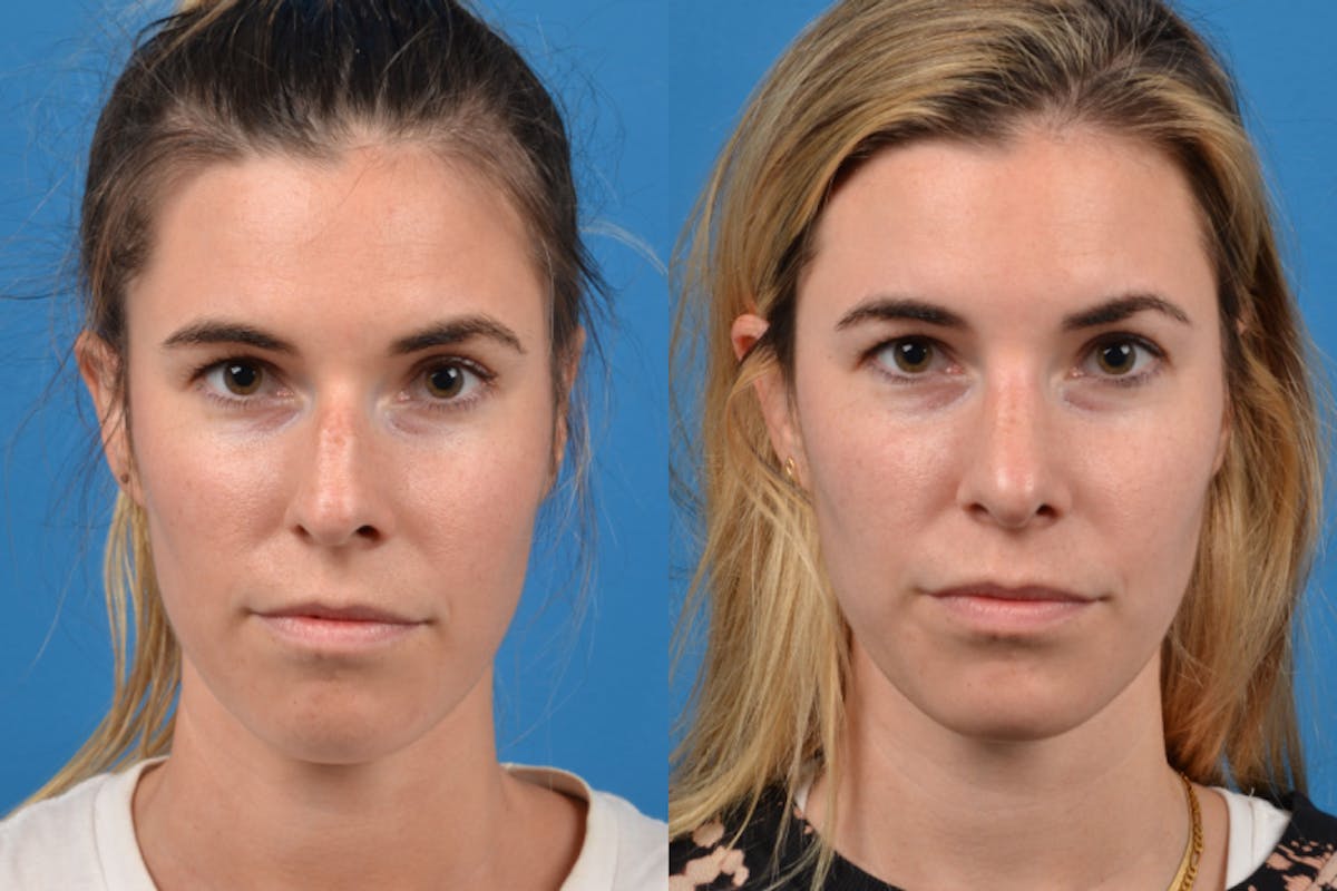 Rhinoplasty Before & After Gallery - Patient 122406943 - Image 1