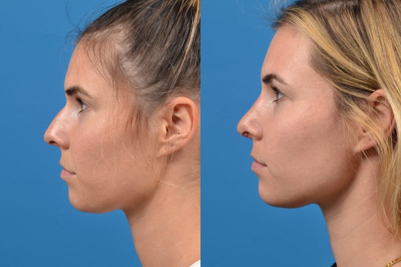 Rhinoplasty Before & After Gallery - Patient 122406943 - Image 2
