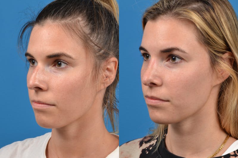 Rhinoplasty Before & After Gallery - Patient 122406943 - Image 3