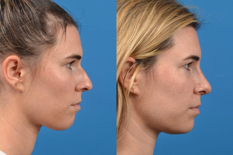 Rhinoplasty Before & After Gallery - Patient 122406943 - Image 4