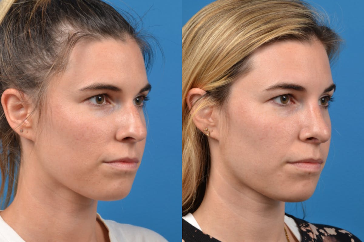 Rhinoplasty Before & After Gallery - Patient 122406943 - Image 5