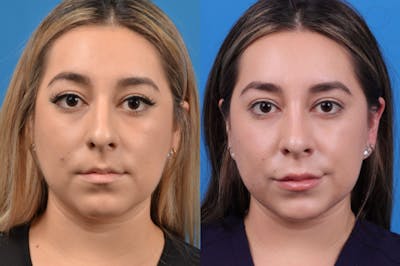 Rhinoplasty Before & After Gallery - Patient 122406944 - Image 1