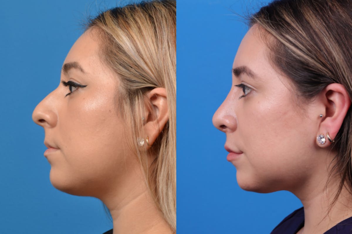 Rhinoplasty Before & After Gallery - Patient 122406944 - Image 2