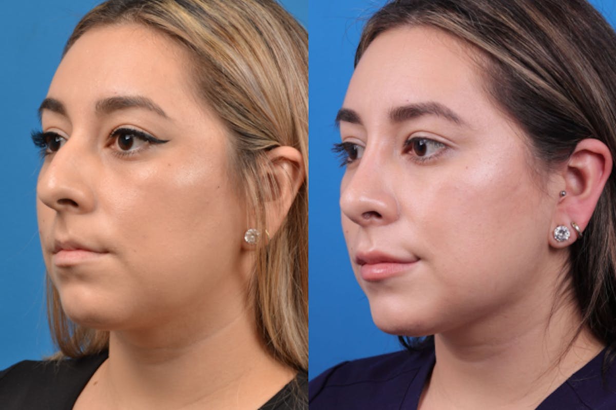 Rhinoplasty Before & After Gallery - Patient 122406944 - Image 3