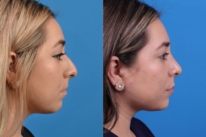 Rhinoplasty Before & After Gallery - Patient 122406944 - Image 4