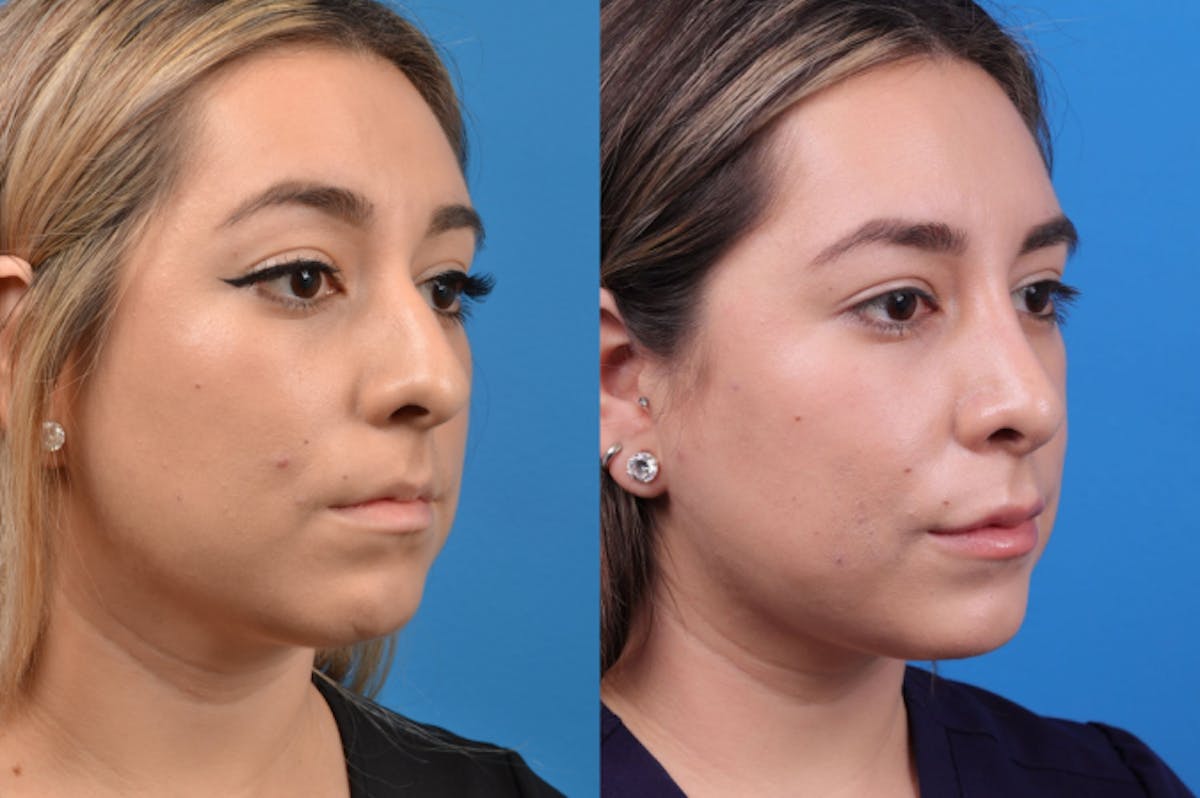 Rhinoplasty Before & After Gallery - Patient 122406944 - Image 5