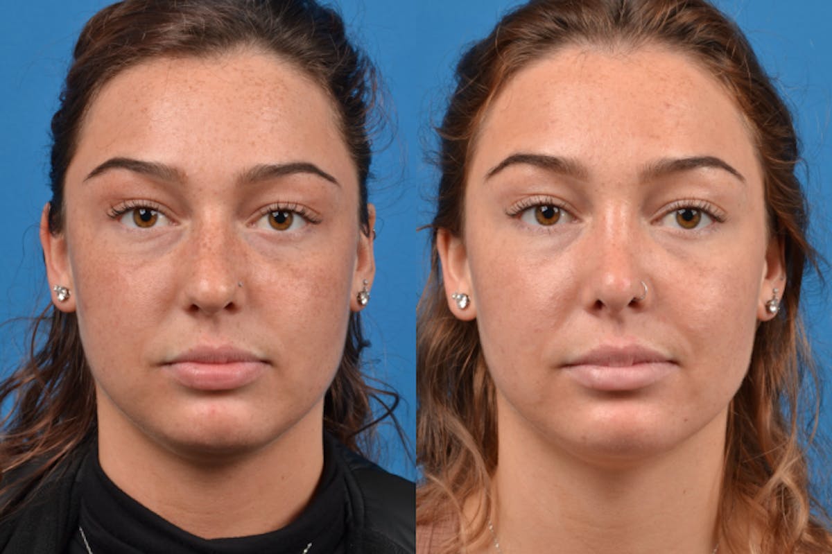 Rhinoplasty Before & After Gallery - Patient 122406945 - Image 1