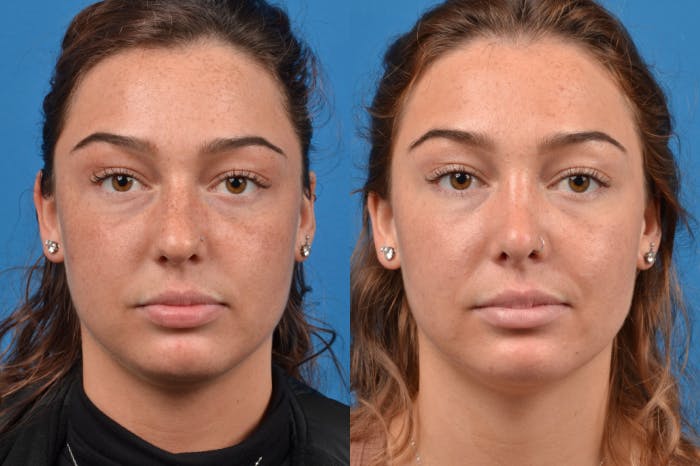 Rhinoplasty Before & After Gallery - Patient 122406945 - Image 1