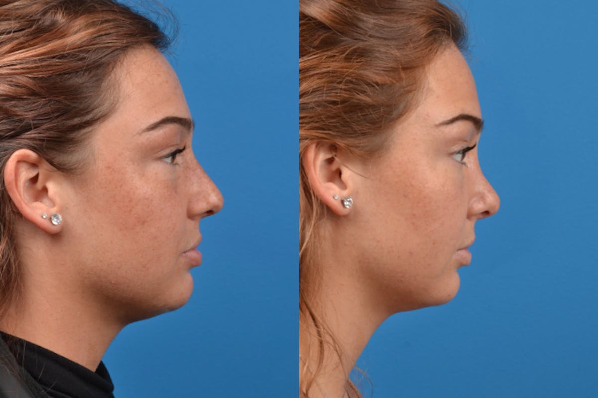 Rhinoplasty Before & After Gallery - Patient 122406945 - Image 2