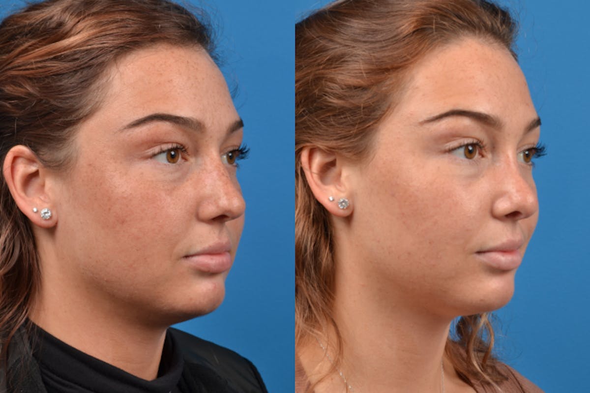 Rhinoplasty Before & After Gallery - Patient 122406945 - Image 3