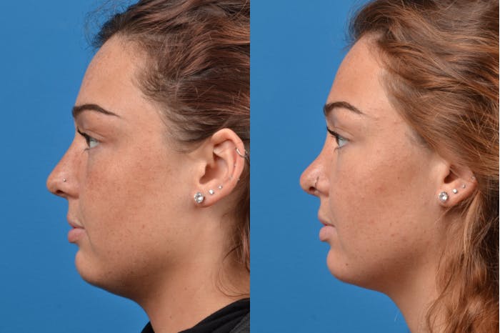 Rhinoplasty Before & After Gallery - Patient 122406945 - Image 4